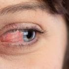 Bỏng mắt có biểu hiện như thế nào?