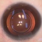 Vì sao ICL phù hợp với người không đủ điều kiện mổ LASIK