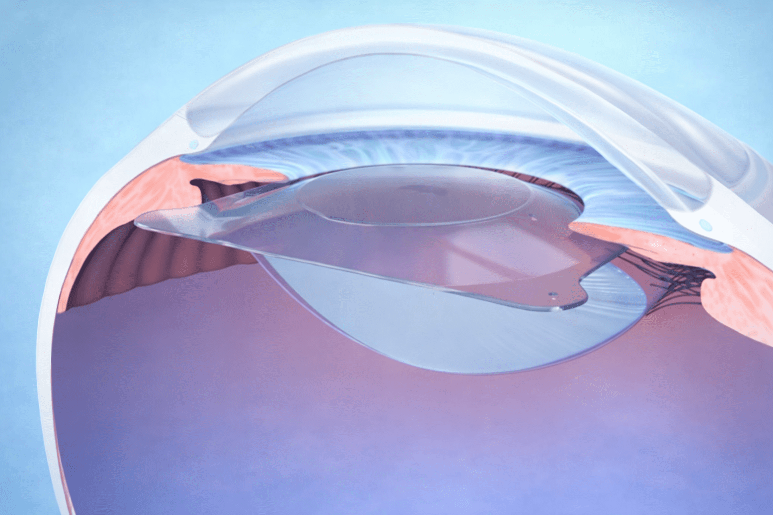 Why ICL is suitable for patients who are not eligible for LASIK