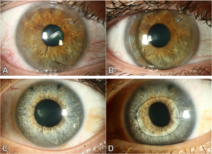 Phakic ICL procedure