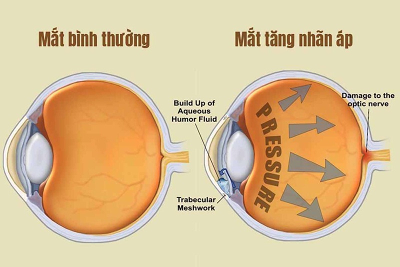 Phân loại áp lực nội nhãn