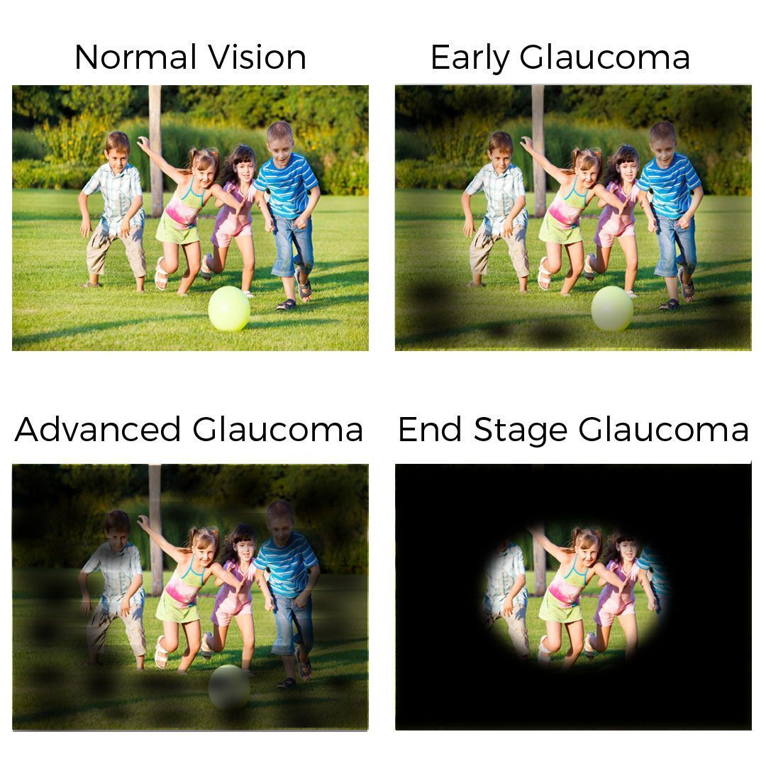 Vì sao Glaucoma nguy hiểm? Dấu hiệu thường gặp