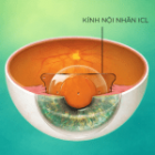 Xóa cận Phakic ICL tại Bệnh viện Mắt Ánh Sáng
