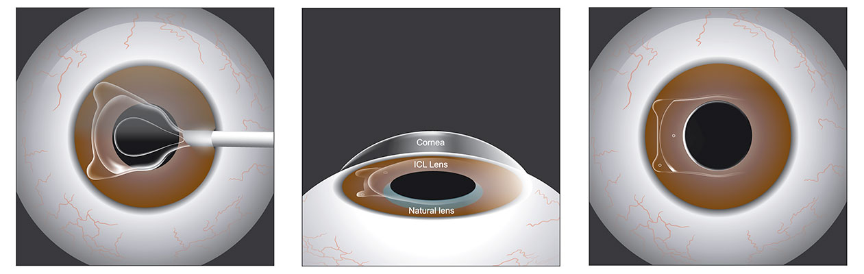 Common questions about Phakic ICL surgery