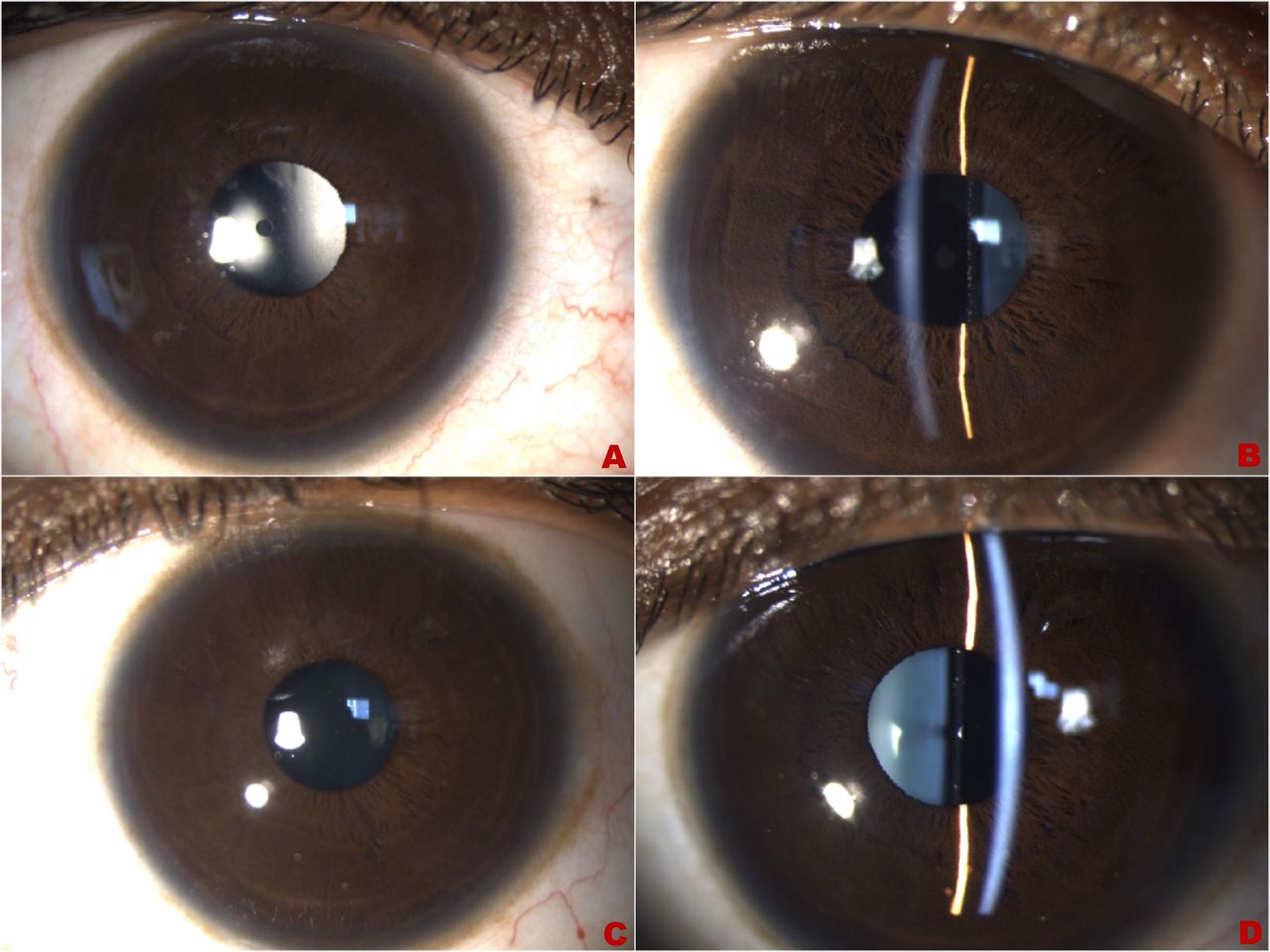 Quy trình phẫu thuật Phakic ICL