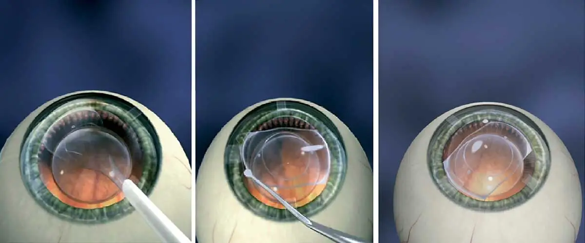 Vì sao chi phí Phakic ICL cao hơn LASIK?