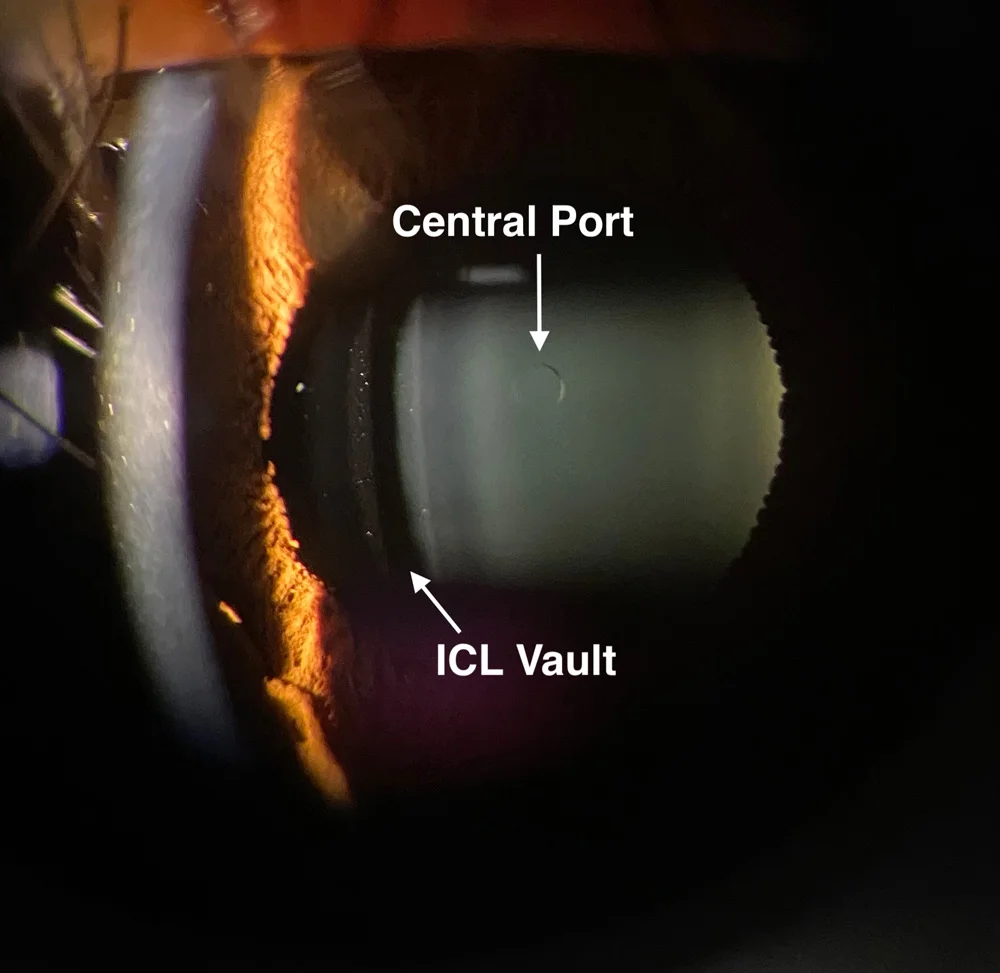 Phakic ICL thường áp dụng cho mức độ cận thị nào?