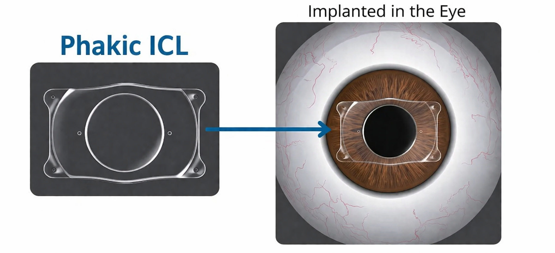Khám phá phương pháp mổ mắt cận thị Phakic ICL mới nhất
