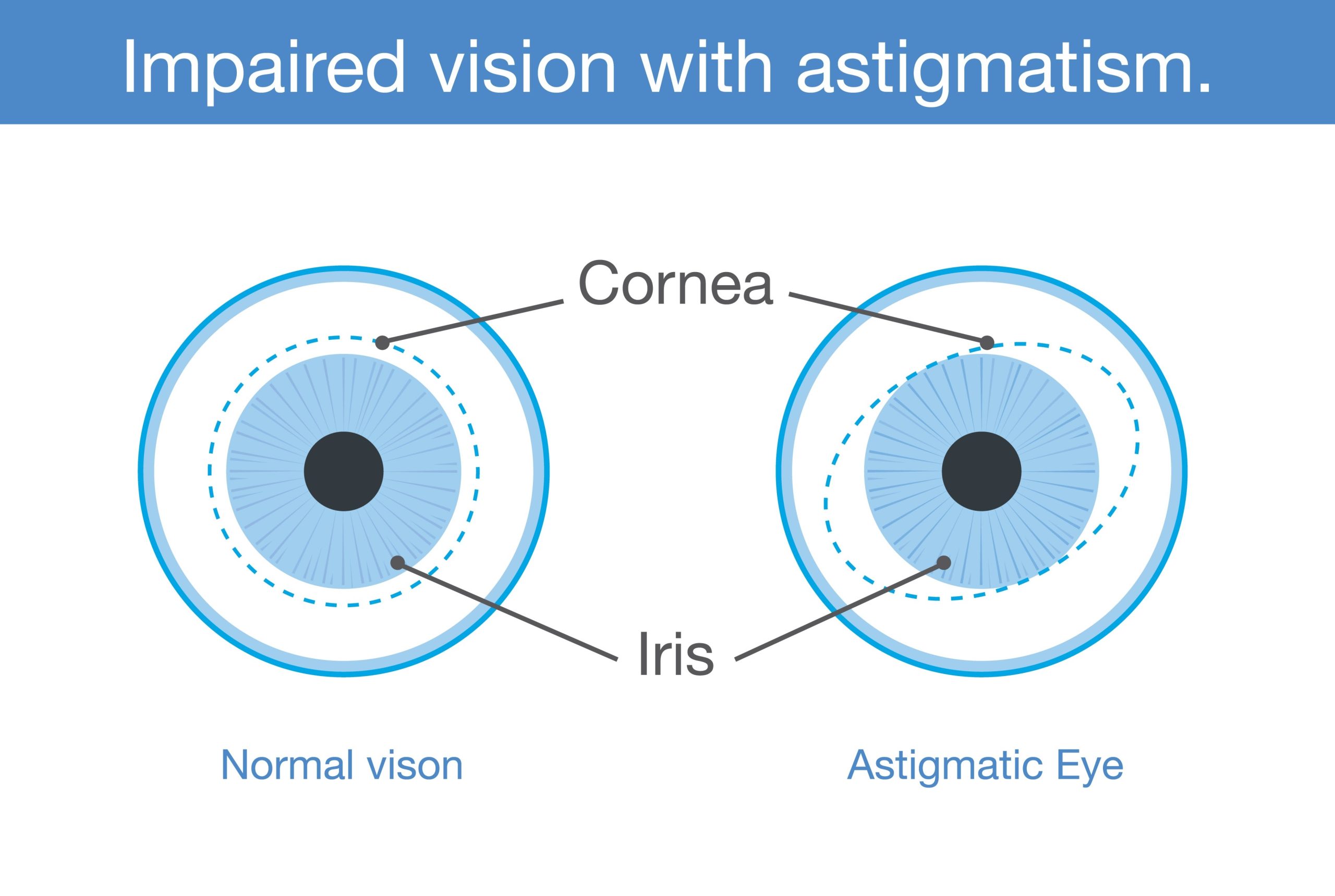 Comparison between an astigmatic eye and a normal eye