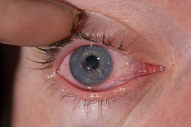 Corneal injuries not only cause pain but also carry a risk of vision loss if not treated promptly.