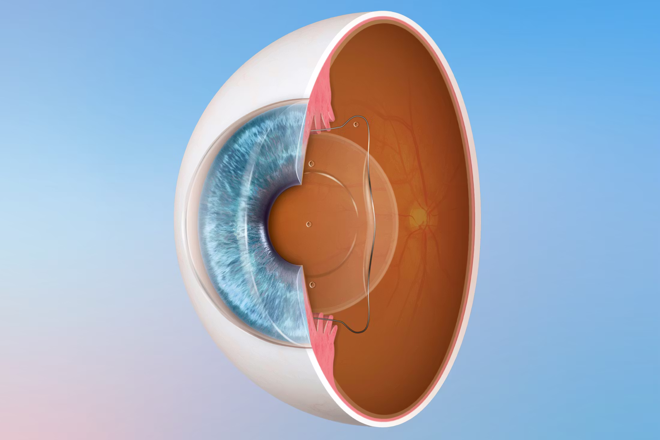 Những ưu điểm nổi bật của Phakic ICL trong điều trị tật khúc xạ