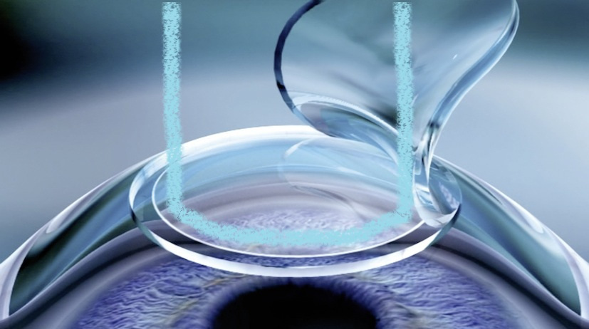 Chi phí phẫu thuật LASIK