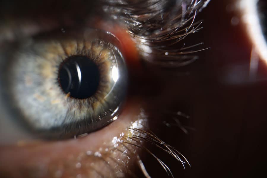 Eye After Phakic ICL Implantation Surgery