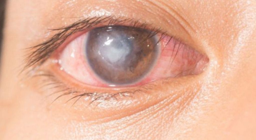 Corneal haze following surface ablation surgery