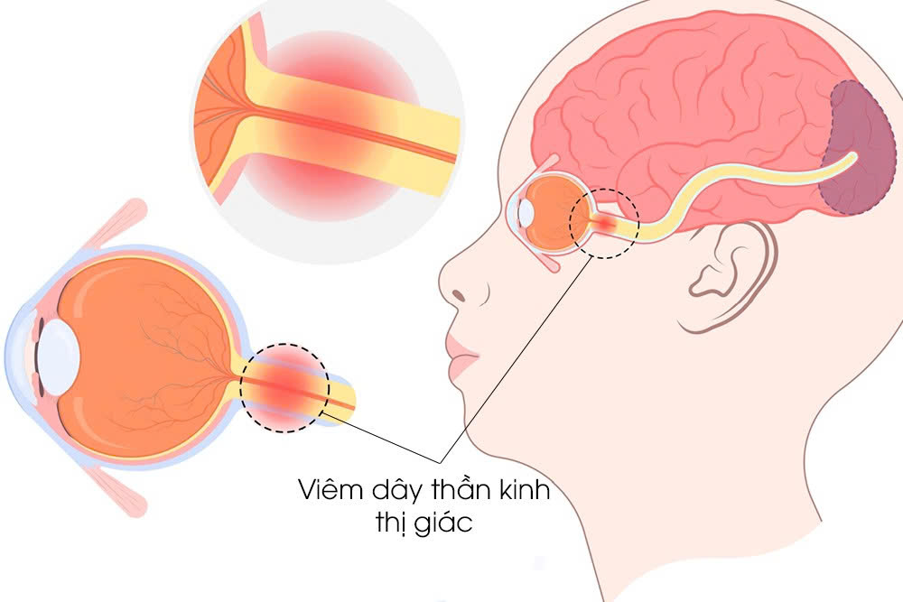 Viêm thần kinh thị giác
