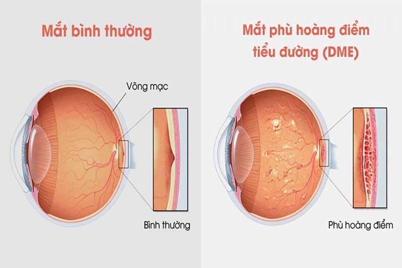 Mắt bình thường và Mắt phù hoàng điểm tiểu đường