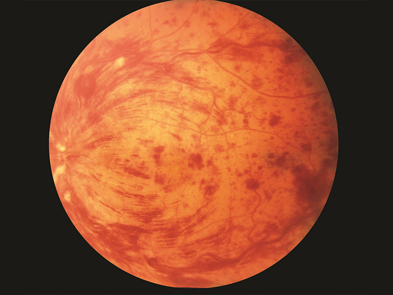Central retinal vein occlusion