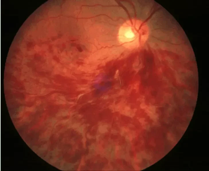 Branch retinal vein occlusion
