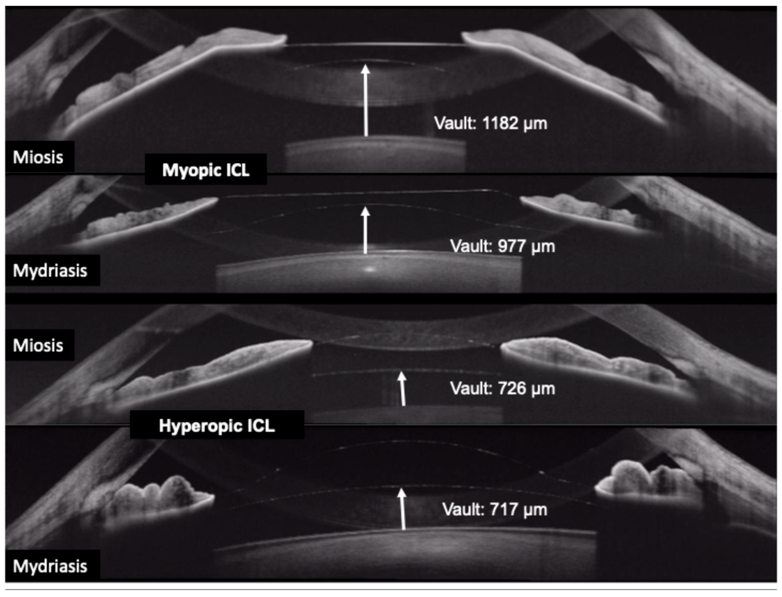 Anterior segment measurements obtained with ANTERION for Phakic ICL surgery