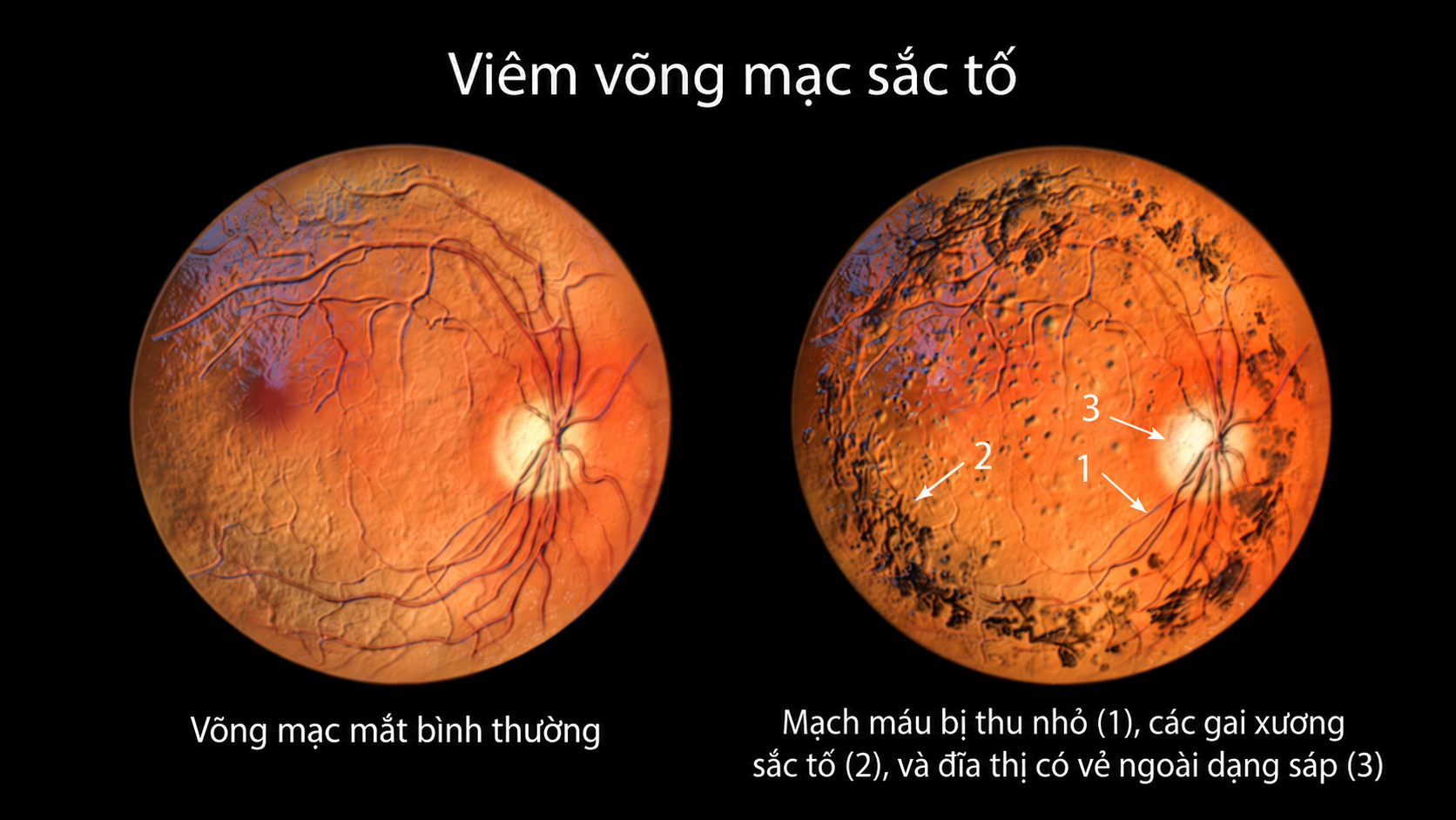 Normal eye and eye with retinitis pigmentosa