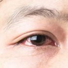 Dị ứng mắt: Nguyên nhân, triệu chứng và cách phòng ngừa hiệu quả